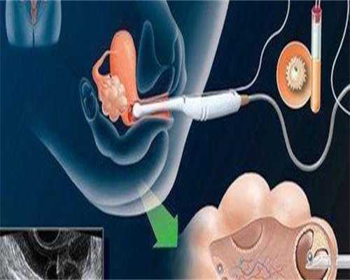 代生公司价格-宫颈口息肉可以做试管吗,宫颈口息肉可以做试管吗多少钱